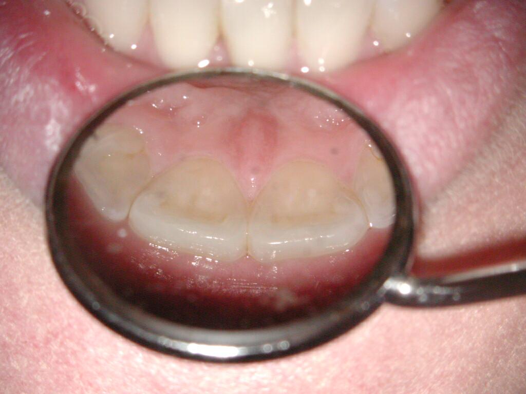 Upper Incisor at lower incisors 3 .jpg